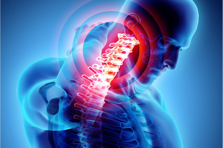 Kyphosis: causes, symptoms and treatment - BackPainSources